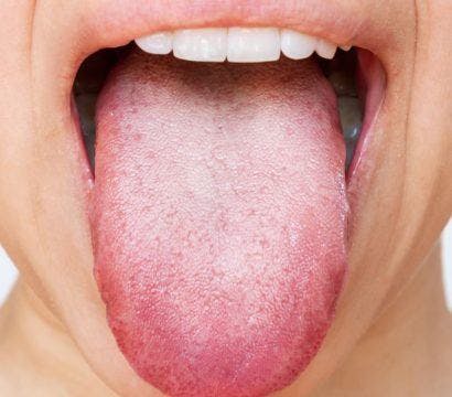 A woman sticks out her tongue displaying a white coating.