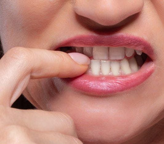 A woman pointing to her chipped tooth.