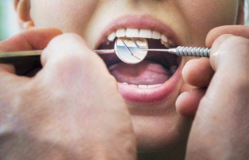 Closeup of mouth undergoing a dental checkup. 