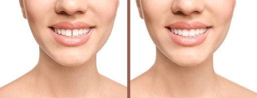 Side-by-side comparison of a woman’s mouth showing diastema and a closed gap. 