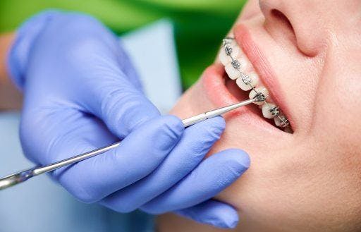 Closeup of dentist fixing metal braces.