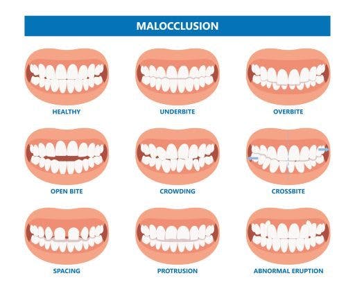 Illustration of different malocclusions. 