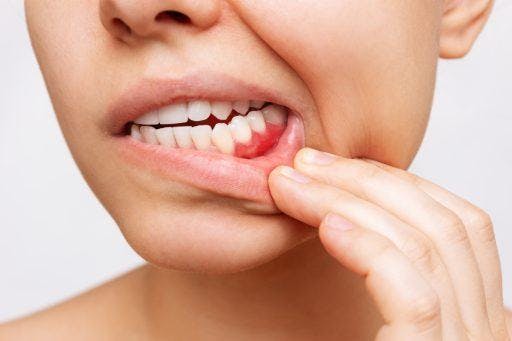 Closeup photo of a woman who pulls downs her bottom lip with her hand to check her teeth and gums