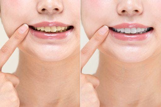 Side-by-side comparison of yellow teeth and whiter teeth.