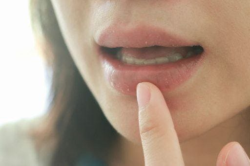 A young woman with her mouth partly open points a finger at her dry lips. 
