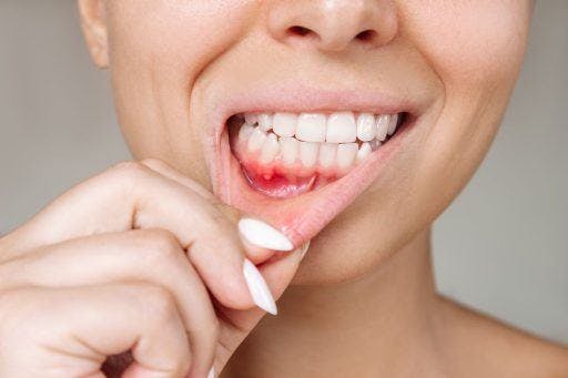 A woman pulls her lip to show swollen gums underneath.