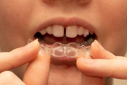 A woman with a gap between her two front teeth putting on clear aligners.