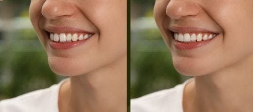 Before and after photos of a woman with a gap between her two front teeth. 