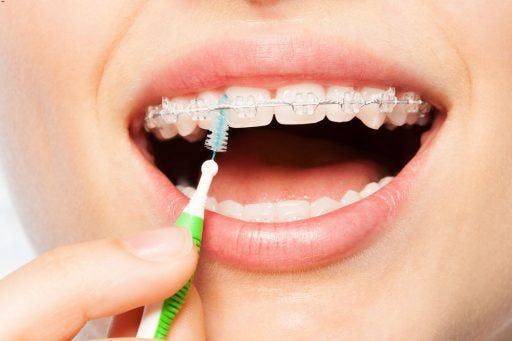 Close-up of a woman using an interdental brush to clean under the wire of her braces.