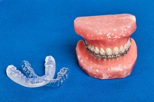 A teeth model with traditional braces beside removable orthodontic appliances. 