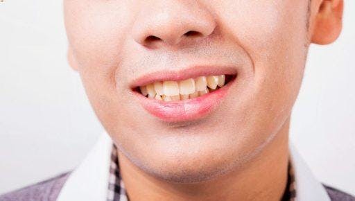A man smiling with discoloured teeth.