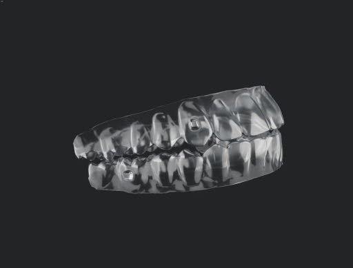 Clear aligners customised for attachments. 