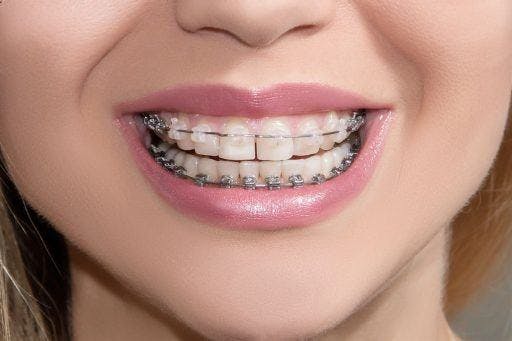 Close-up of a woman smiling with ceramic braces on the top row and metal braces on the bottom row of teeth.