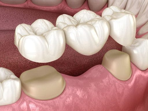 A digital model of dental bridges fitting over molars.