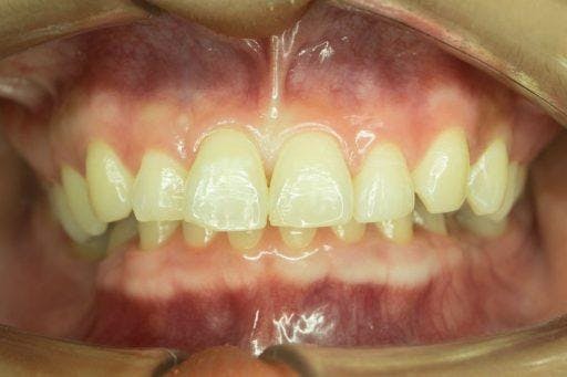 Overbite or deep bite teeth close-up.