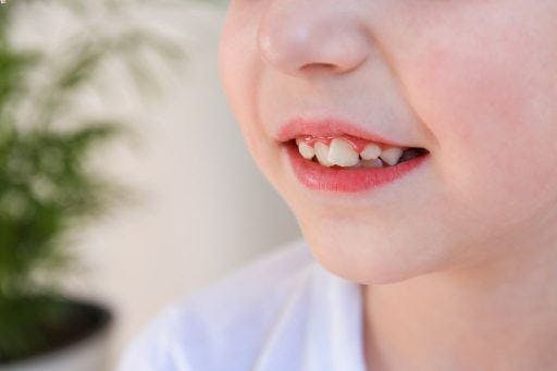 Close-up of a child with crooked baby teeth.