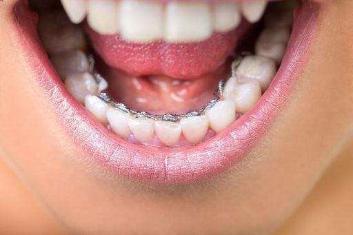 Close-up of lingual braces.